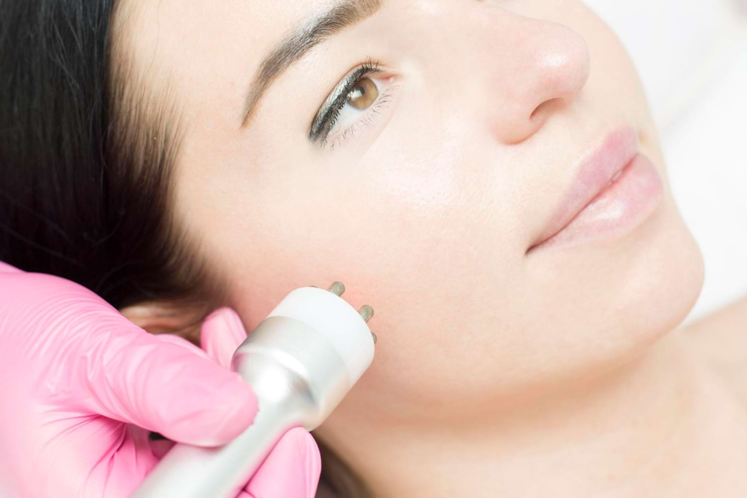 radiofrekwencja mikroigłowa